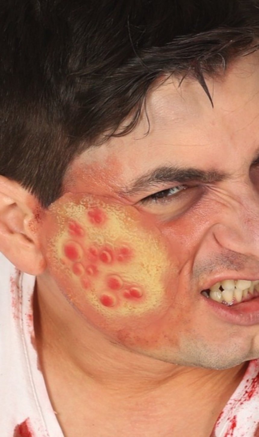 Plaie Ampoules en Latex